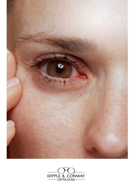 Woman with a red, dry eye